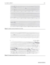 Báo cáo y học A case of mistaken identity Asystole causing convulsions identified using implantable loop recorder