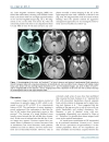 Báo cáo y học Mirror Image Arachnoid Cysts in a Pair of Monozygotic Twins A Case Report and Review of the Literature