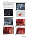 Báo cáo y học Treatment of oroantral fistula with autologous bone graft and application of a non reabsorbable membrane