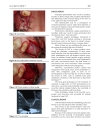 Báo cáo y học Treatment of oroantral fistula with autologous bone graft and application of a non reabsorbable membrane