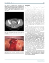 Báo cáo y học Spontaneous Hemoperitoneum Caused By a Diverticulum of the Sigmoid Colon