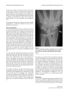 Báo cáo y học An unusual case of gout in the wrist the importance of monitoring medication dosage and interaction A case report