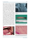 Báo cáo y học Spindle Cell Lipoma of the Hypopharynx