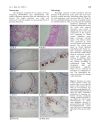 Báo cáo y học The characterisation of mucin in a mature ovarian teratoma occurring in an eight year old patient