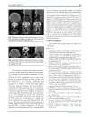 Báo cáo y học Aplasia and Agenesis of the Frontal Sinus in Turkish Individuals A Retrospective Study Using Dental Volumetric Tomograph