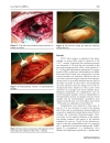 Báo cáo y học Vacuum assisted closure in the treatment of early hip joint infection