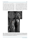 Báo cáo y học Foramen Magnum Arachnoid Cyst Induces Compression of the Spinal Cord and Syringomyelia Case Report and Literature Review