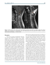 Báo cáo y học Foramen Magnum Arachnoid Cyst Induces Compression of the Spinal Cord and Syringomyelia Case Report and Literature Review