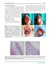 Báo cáo y học Prevention of Pleural Adhesions Using a Membrane Containing Polyethylene Glycol