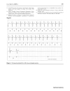 Báo cáo y học Differentiation of convulsive syncope from epilepsy with an implantable loop recorder Khalil Kanjwal Beverly Karabin Yousuf Kanjwal Blair P Grubb