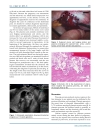 Báo cáo y học Placenta Percreta Induced Uterine Rupture Diagnosed By Laparoscopy in the First Trimester