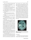 Báo cáo y học Post traumatic glioma Report of one case and review of the literature