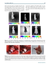 Báo cáo y học ntravenous transplantation of allogeneic bone marrow mesenchymal stem cells and its directional migration to the necrotic femoral head