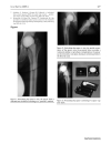 Báo cáo y học Mechanical complications and reconstruction strategies at the site of hip spacer implantation