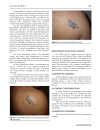 Báo cáo y học Surgical Removal of lipoma from an area with tattooed skin