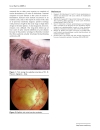 Báo cáo y học Ocular manifestations of Lyme borreliosis in Europe