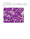 Báo cáo y học ribriform Morular Variant of Papillary Carcinoma Association with Familial Adenomatous Polyposis Report of Three Cases and Review of Literature