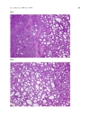 Báo cáo y học ribriform Morular Variant of Papillary Carcinoma Association with Familial Adenomatous Polyposis Report of Three Cases and Review of Literature