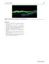 Báo cáo y học Optical Coherence Tomography in ocular toxoplasmosis