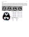 Báo cáo y học Comparison of Classical and Clozapine Treatment on Schizophrenia Using Positive and Negative Syndrome Scale of Schizophrenia PANSS and SPECT Imaging