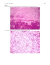 Báo cáo y học Malignant phyllodes tumor with heterologous liposarcomatous differentiation and tubular adenoma like epithelial component