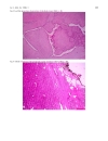 Báo cáo y học Malignant phyllodes tumor with heterologous liposarcomatous differentiation and tubular adenoma like epithelial component