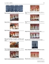 Báo cáo y học Esterified Hyaluronic Acid and Autologous Bone in the Surgical Correction of the Infra Bone Defects