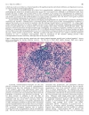 Báo cáo y học Management of HCV Infection and Liver Transplantation