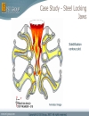 ProCast Case Study 4 Steel Investment Casting