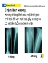 Chậm liền xương không liền xương Hội thảo AO Việt Nam 2009