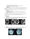 Điều Trị Nội Mạch Một Số Bệnh Lý Mạch Máu Não