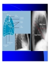 X q lồng ngực phổi