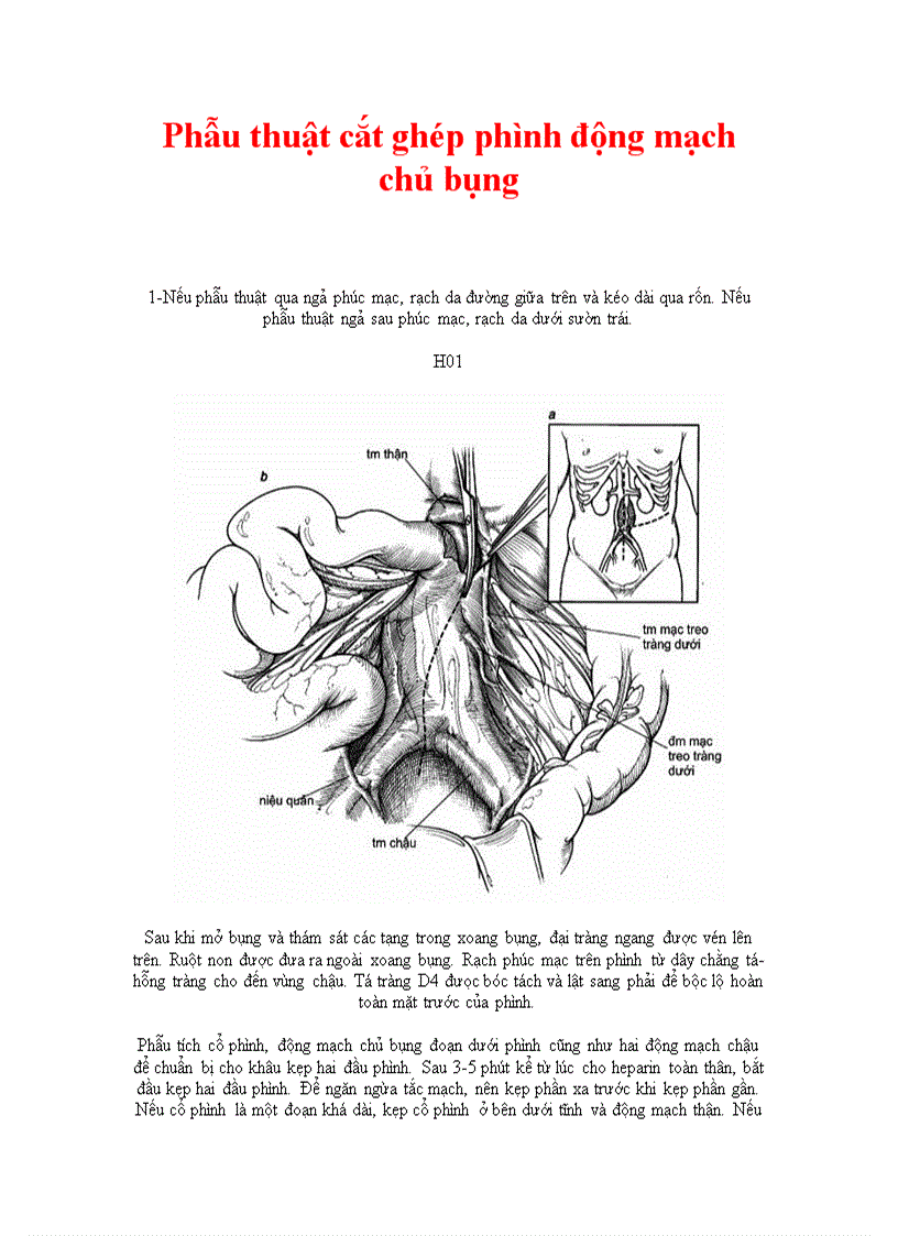 Phẫu thuật cắt ghép phình động mạch chủ bụng