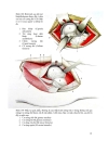 Đường mổ qua mông bauer