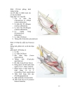 Đường mổ xương chậu theo cung đùi Letournel