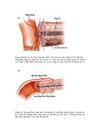Phẫu thuật cắt khối tá tuỵ bảo tồn môn vị