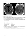 Ct trong chẩn đoán đột quỵ não