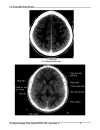 Ct trong chẩn đoán đột quỵ não