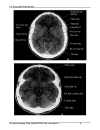 Ct trong chẩn đoán đột quỵ não