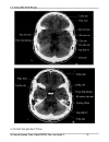 Ct trong chẩn đoán đột quỵ não