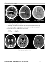 Ct trong chẩn đoán đột quỵ não