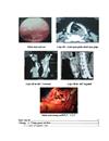 Nghiên cứu đặc điểm lâm sàng chụp cắt lớp vi tính đối chiếu với phẫu thuật của ung thư hạ họng