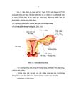 Nhận xét về kết quả điều trị u nang buồng trứng bằng phẫu thuật nội soi tại BVPSTƯ trong 6 tháng đầu năm 2008 1