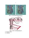 Nghiên cứu áp dụng và bước đầu đánh giá hiệu quả của phương pháp gây tắc động mạch tử cung trong điều trị chảy máu sau đẻ 1