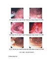 Nhận xét hình ảnh nội soi mô bệnh học của polyp đại trực tràng và kết quả cắt polyp bằng nguồn cắt ENDOPLASMA