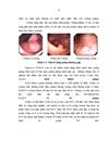 Nhận xét hình ảnh nội soi mô bệnh học của polyp đại trực tràng và kết quả cắt polyp bằng nguồn cắt ENDOPLASMA