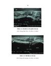 Nghiên cứu giá trị của siêu âm trong chẩn đoán bệnh xơ rút cơ delta 1