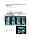 Nghiên cứu chẩn đoán và điều trị phẫu thuật thoát vị đĩa đệm vùng thắt lưng - cùng gây hội chứng đuôi ngựa