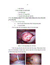 Nhận xét về kết quả điều trị u nang buồng trứng bằng phẫu thuật nội soi tại BVPSTƯ trong 6 tháng đầu năm 2008