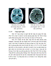Nghiên cứu đặc điểm hình ảnh và giá trị của chụp CLVT trong chẩn đoán u sọ hầu